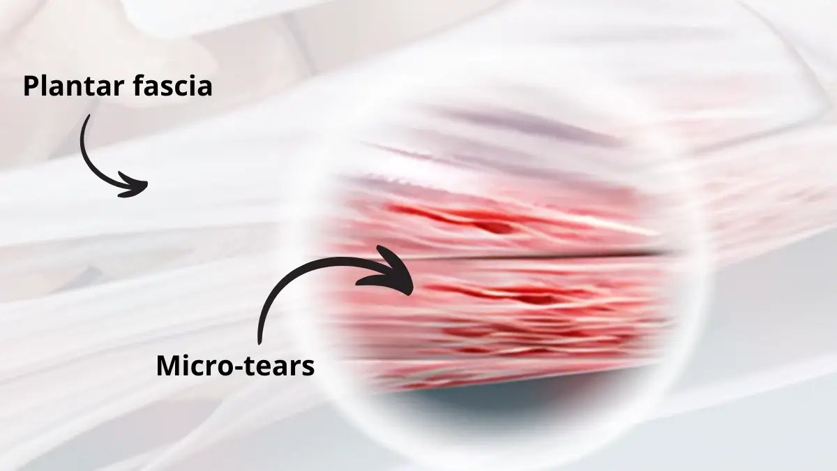 Plantar fascia micro-tears illustration explaining the cause of plantar fasciitis