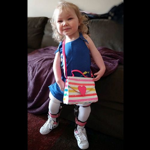 2.5 years old - Ana could only stand while wearing long, metal braces that held her legs straight for her while simultaneousl...