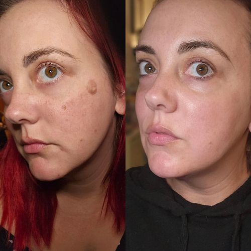 NOT A PAID ADVERTISEMENT wanted to share my progress photos after having Advanced IPL at @dermaenvy ! I am working on a reel ...