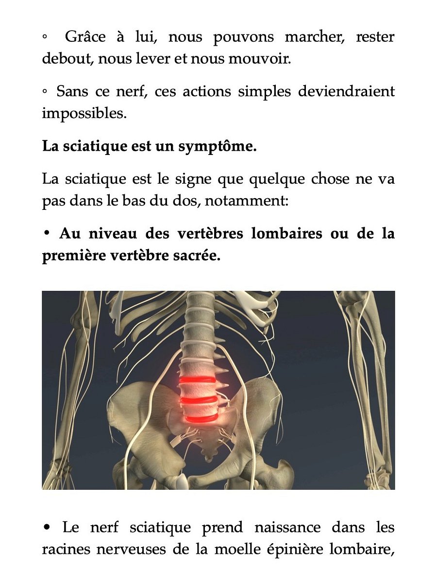 La Sciatique par hernie discale - Comment j'en suis venu à bout product image (6)