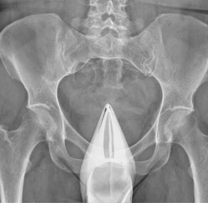 X-Ray Heel Sticker product image (1)