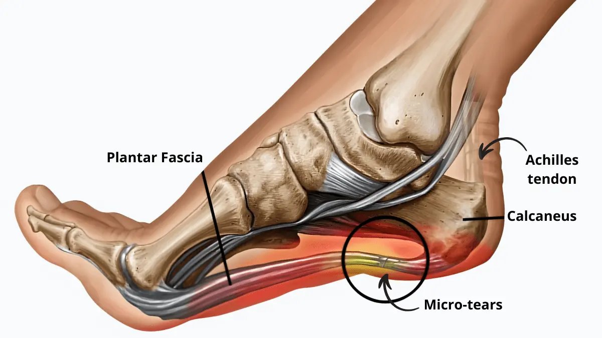heel anatomy showing plantar fascia