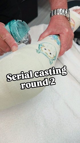 Round two - serial casting into extension at the @paleyinstitute #arthrogryposis #teamamcana