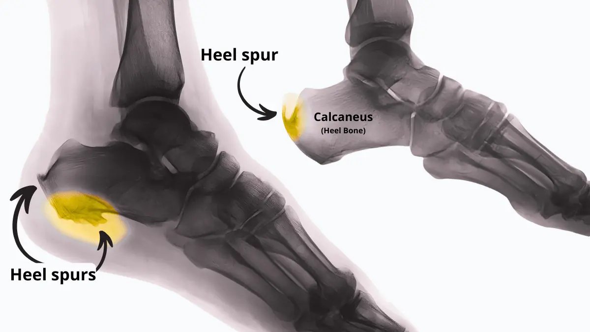 foot X-ray showing heel spur, a common cause of heel pain and plantar fasciitis