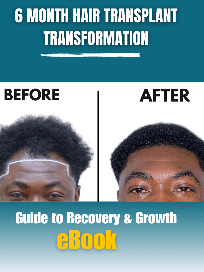 My 6-Month Hair Transplant Transformation Guide product image (1)